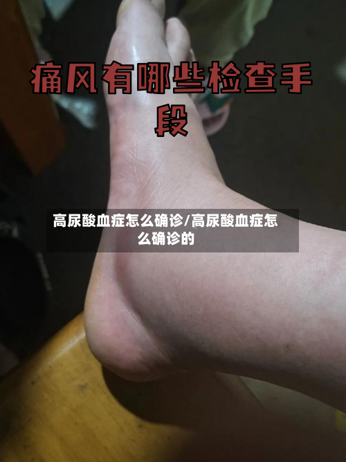 高尿酸血症怎么确诊/高尿酸血症怎么确诊的-第2张图片